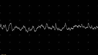 EMG teaching video 14 Endplate noise and spikes [upl. by Ricki]