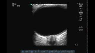 Optic Nerve Ultrasound and Optic Nerve Sheath Diameter ONSD measurement [upl. by Adnilema]